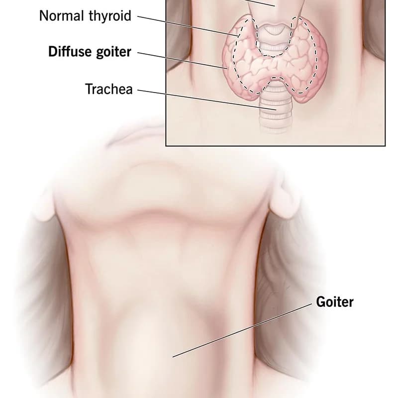 Why drinking garri can potentially cause goiter