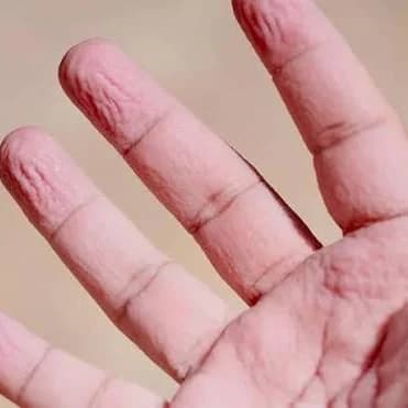 Why Do Your Fingers Wrinkle in Water? 🖐️💧