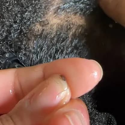 How I Got Rid of Head Lice Without Cutting My Hair